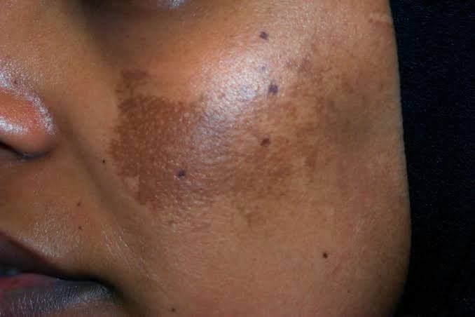 Terobosan Terapi Laser untuk Melasma Rekalsitran
